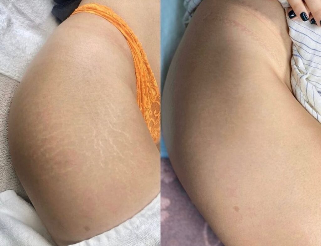 How to get rid of your Lipo Scars? Dark Scar Skin Camouflage treatments Scar  & Stretch Mark Camouflage Medical Tattoos